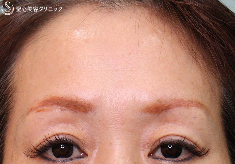 【40代女性・額のシワと瞼の重み改善】眉下切開＆プレミアムPRP皮膚再生療法（2か月後） After 
