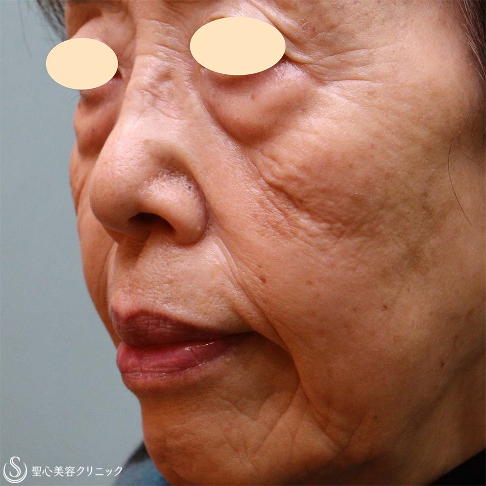 【70代女性・目の下とほうれい線】プレミアムPRP皮膚再生療法（3か月後） Before 