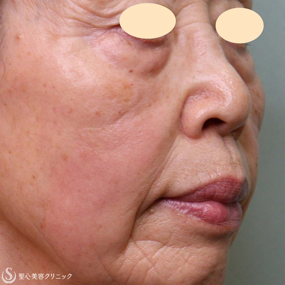 【70代女性・目の下とほうれい線】プレミアムPRP皮膚再生療法（3か月後） After 