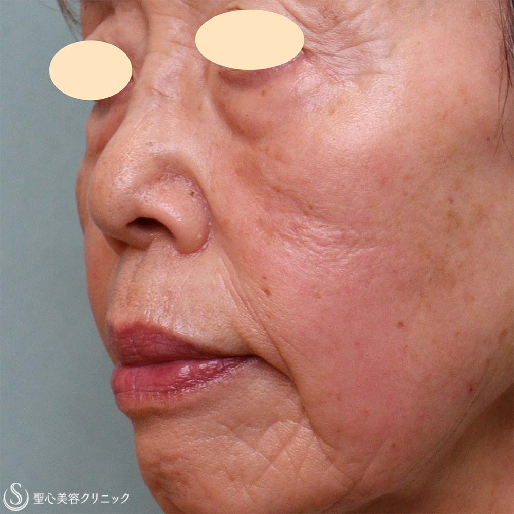 【70代女性・目の下とほうれい線】プレミアムPRP皮膚再生療法（3か月後） After 