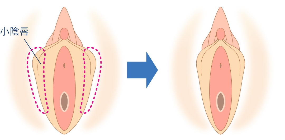 小陰唇縮小とは
