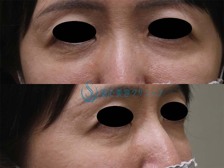 【40代女性・目の下の若返り】プレミアムPRP皮膚再生療法（1年後） Before 