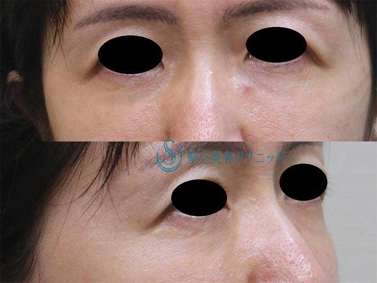 【40代女性・目の下の若返り】プレミアムPRP皮膚再生療法（1年後） After 