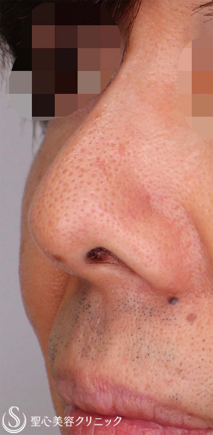 【50代男性・鼻の穴を目立ちにくくしたい！！】鼻孔縁下降術（術後1ヶ月） Before 