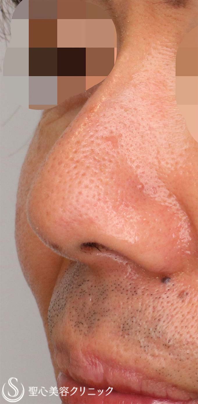 【50代男性・鼻の穴を目立ちにくくしたい！！】鼻孔縁下降術（術後1ヶ月） After 