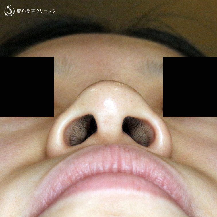 【20代女性・大きな小鼻がお悩み】小鼻縮小術+α法「Ver.5」（1ヶ月後） Before 
