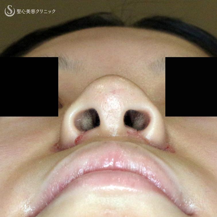 【20代女性・大きな小鼻がお悩み】小鼻縮小術+α法「Ver.5」（1ヶ月後） After 