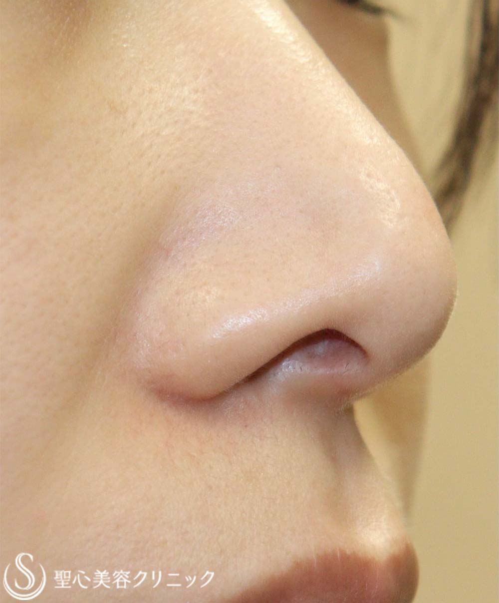 【20代女性・鼻の穴が見えるのが気になる】鼻孔縁下降術（3ヶ月後） Before 
