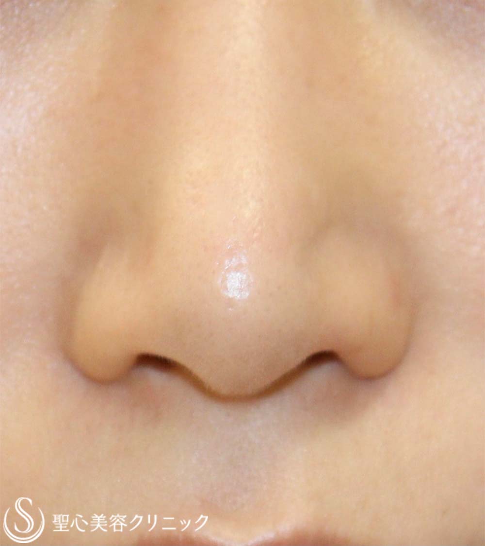 【20代女性・鼻の穴が見えるのが気になる】鼻孔縁下降術（3ヶ月後） After 