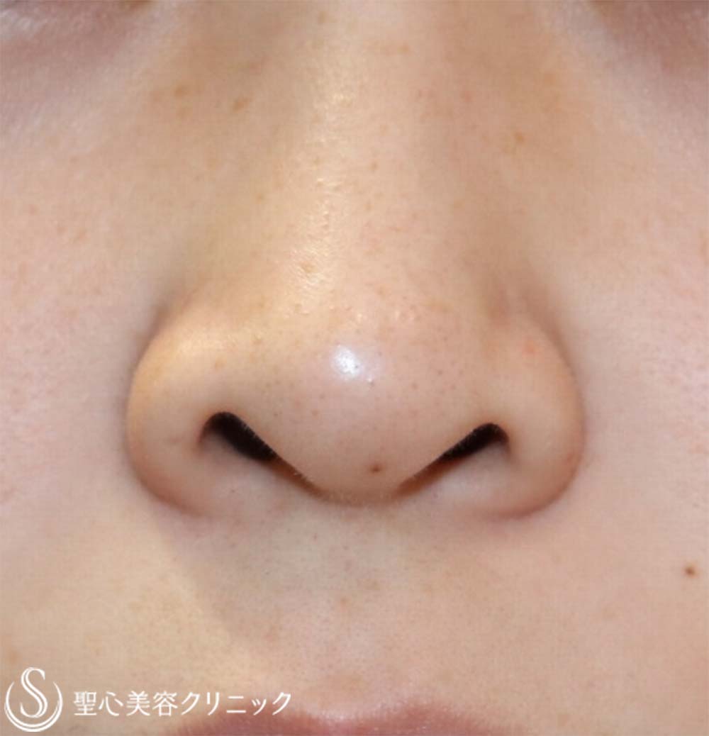 【30代女性・鼻の穴が見えるのが気になる】鼻孔縁下降術（7ヶ月後） Before 