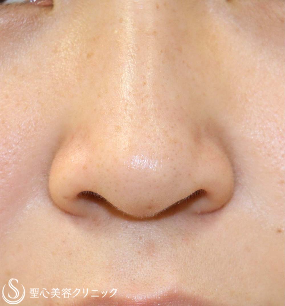 【30代女性・鼻の穴が見えるのが気になる】鼻孔縁下降術（7ヶ月後） After 