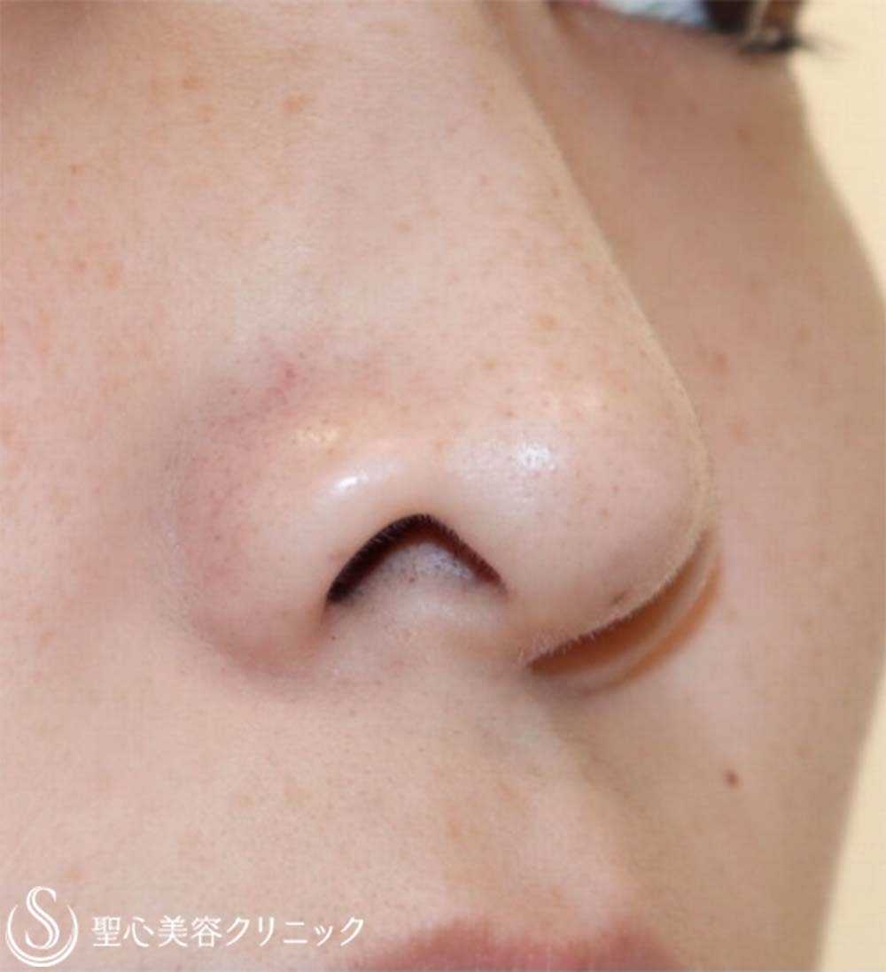 【30代女性・鼻の穴が見えるのが気になる】鼻孔縁下降術（7ヶ月後） Before 