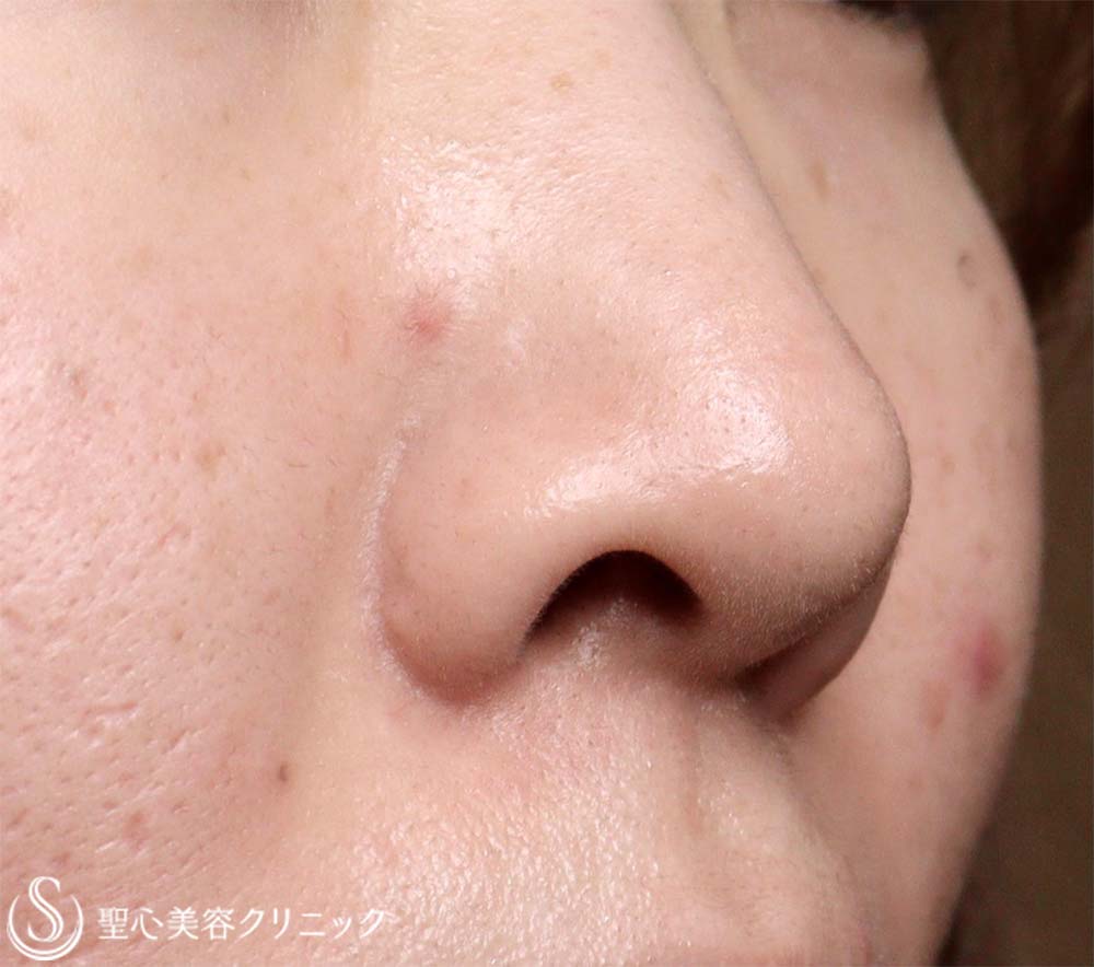 【20代女性・鼻の穴が見えるのが気になる】鼻孔縁下降術（7日後） Before 
