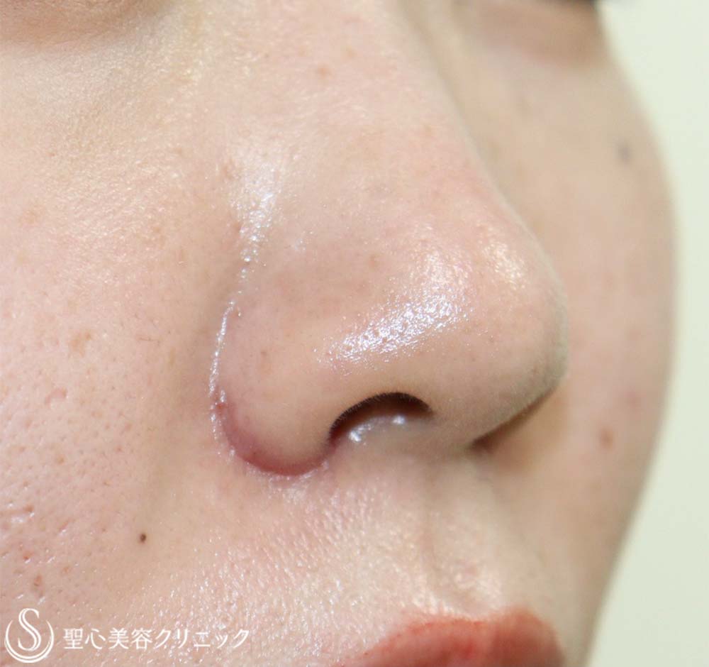 【20代女性・鼻の穴が見えるのが気になる】鼻孔縁下降術（7日後） After 