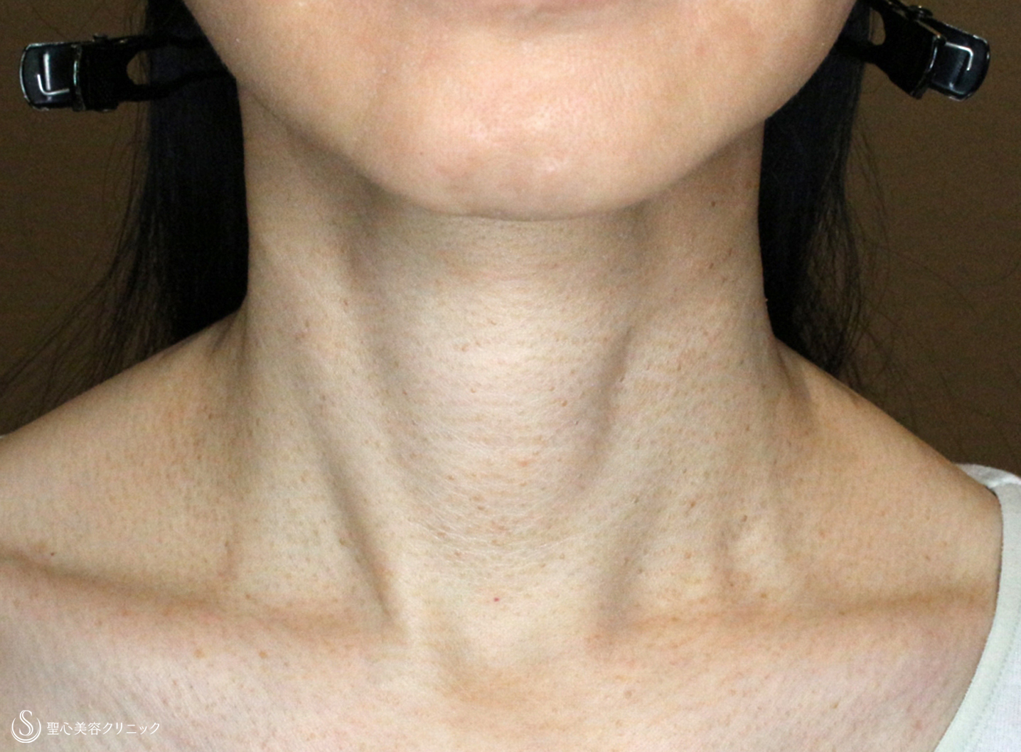 【40代女性・首の横じわを無かったことに】プレミアムPRP皮膚再生療法（5年後） After 