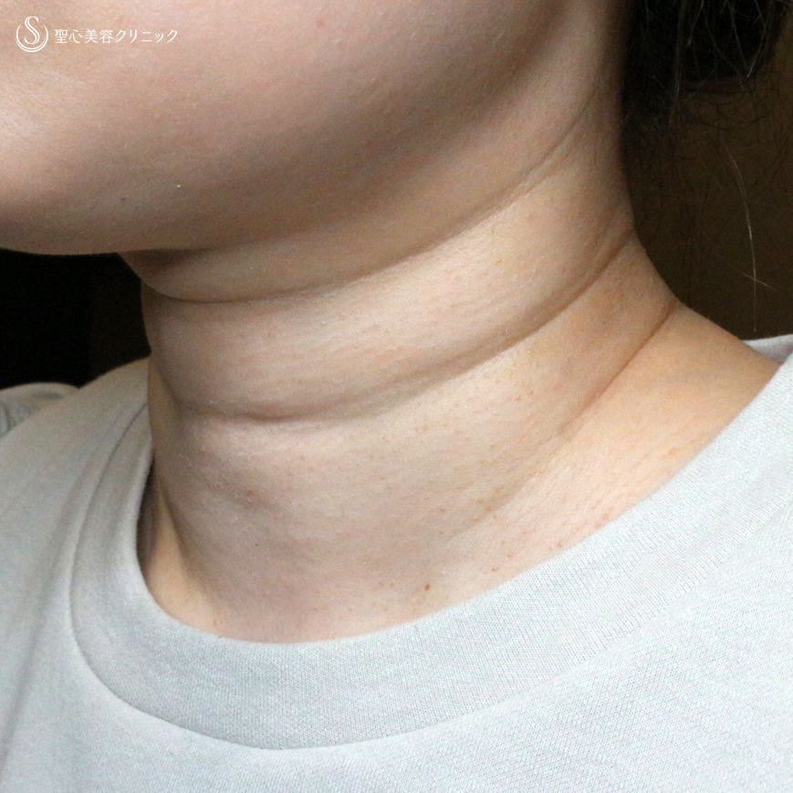 【30代女性・首の横ジワで難しい「ミシュラン」タイプ】プレミアムPRP皮膚再生療法（10ヶ月後） Before 