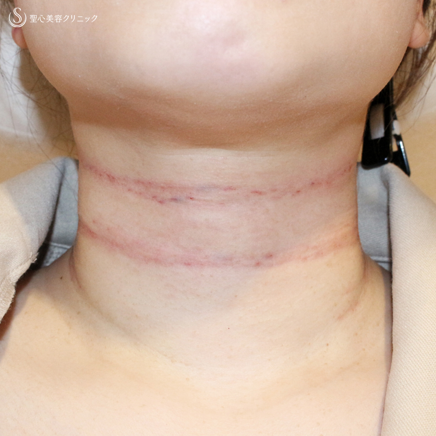 【30代女性・首の横ジワで難しい「ミシュラン」タイプ】プレミアムPRP皮膚再生療法（10ヶ月後） Before 