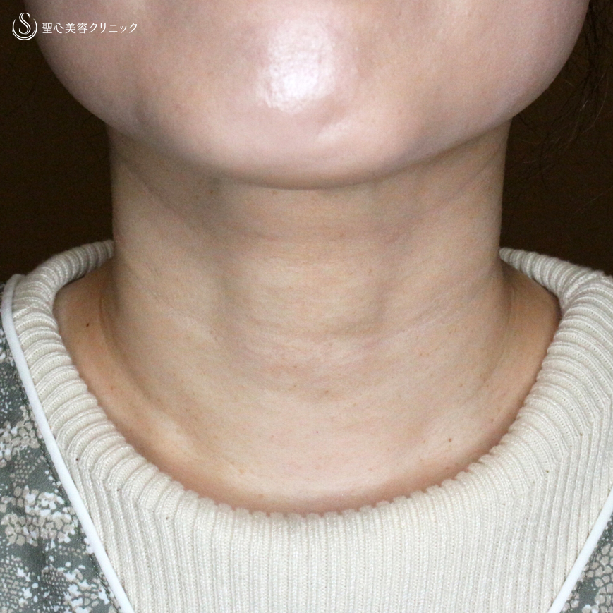 【30代女性・首の横ジワで難しい「ミシュラン」タイプ】プレミアムPRP皮膚再生療法（10ヶ月後） After 