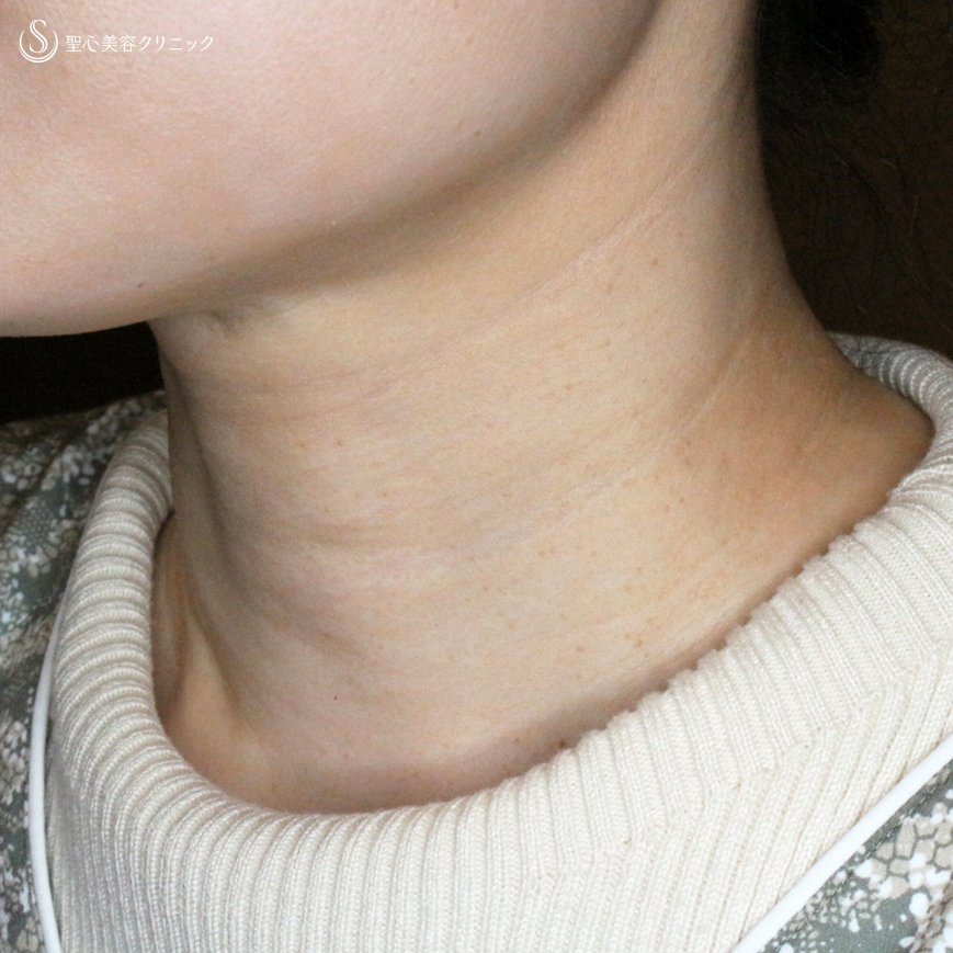 【30代女性・首の横ジワで難しい「ミシュラン」タイプ】プレミアムPRP皮膚再生療法（10ヶ月後） After 
