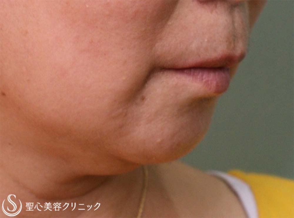 【60代女性・マリオネットライン】プレミアムPRP皮膚再生療法（9ヶ月後） Before 