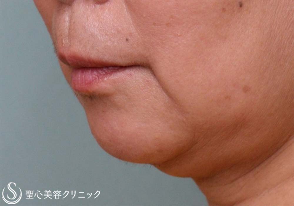 【60代女性・マリオネットライン】プレミアムPRP皮膚再生療法（9ヶ月後） Before 