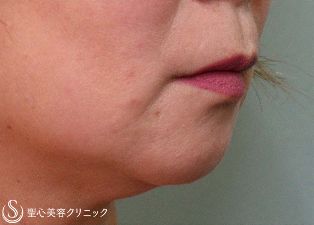 【60代女性・マリオネットライン】プレミアムPRP皮膚再生療法（9ヶ月後） After 