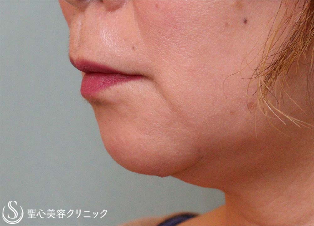 【60代女性・マリオネットライン】プレミアムPRP皮膚再生療法（9ヶ月後） After 
