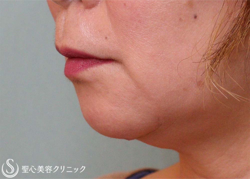 【60代女性・マリオネットライン】プレミアムPRP皮膚再生療法（9ヶ月後） After 