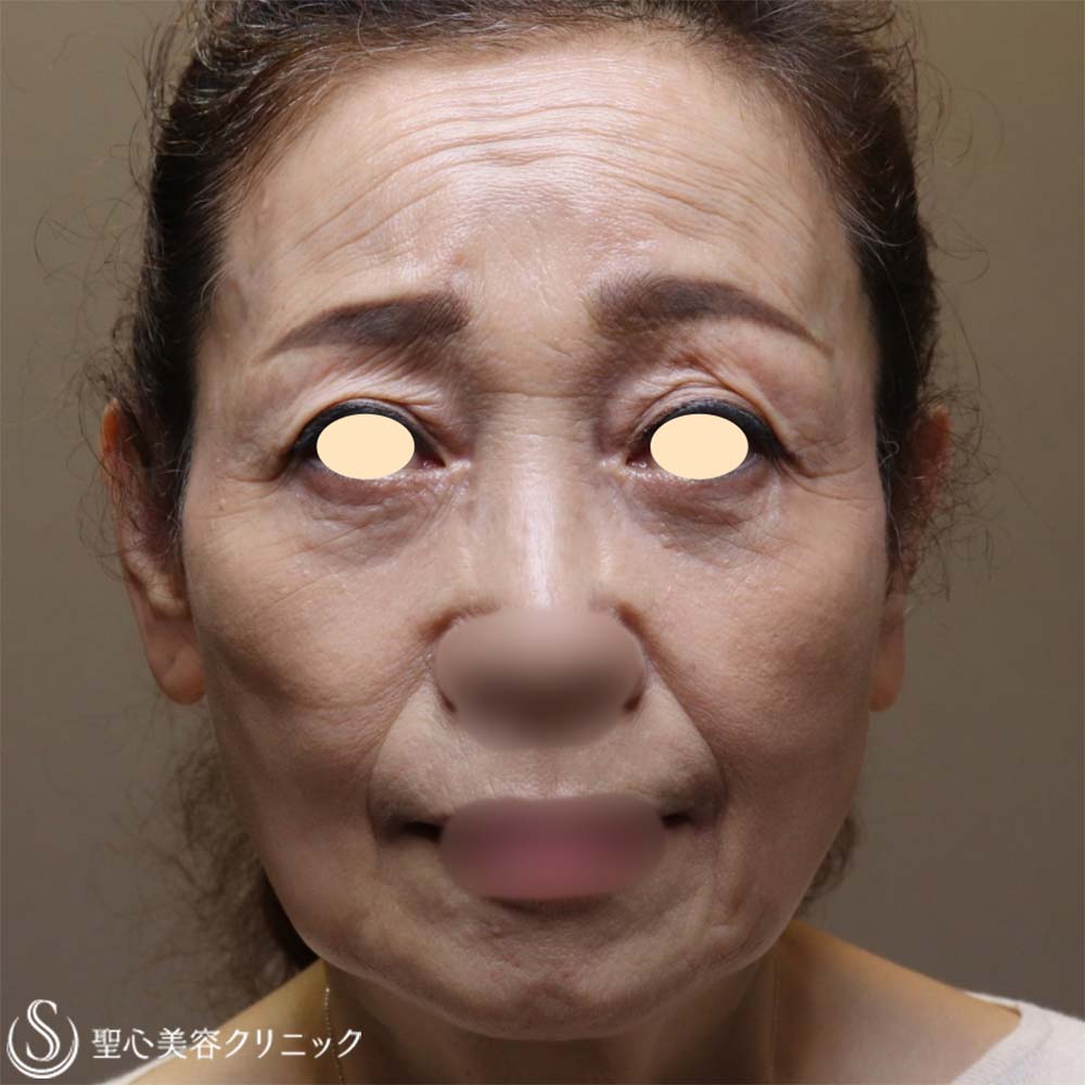 【70代女性・お顔全体の若返り】プレミアムPRP皮膚再生療法（6ヶ月後） Before 