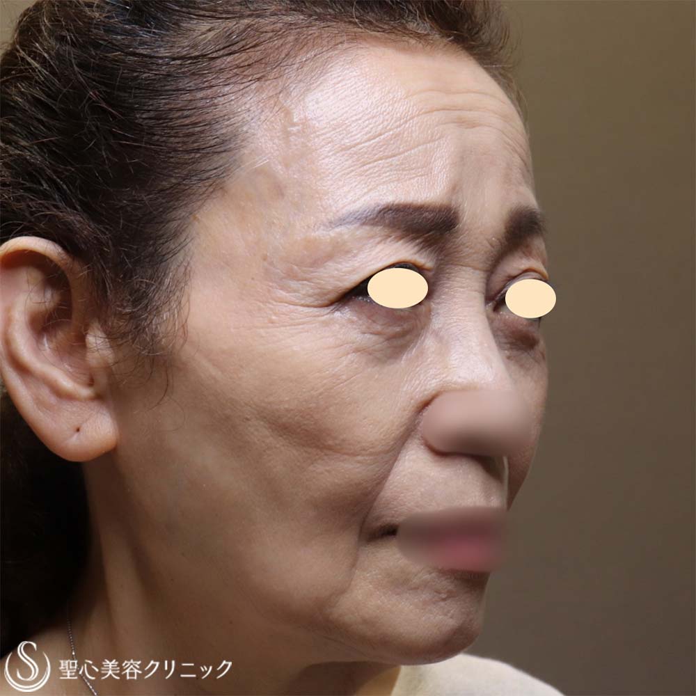 【70代女性・お顔全体の若返り】プレミアムPRP皮膚再生療法（6ヶ月後） Before 
