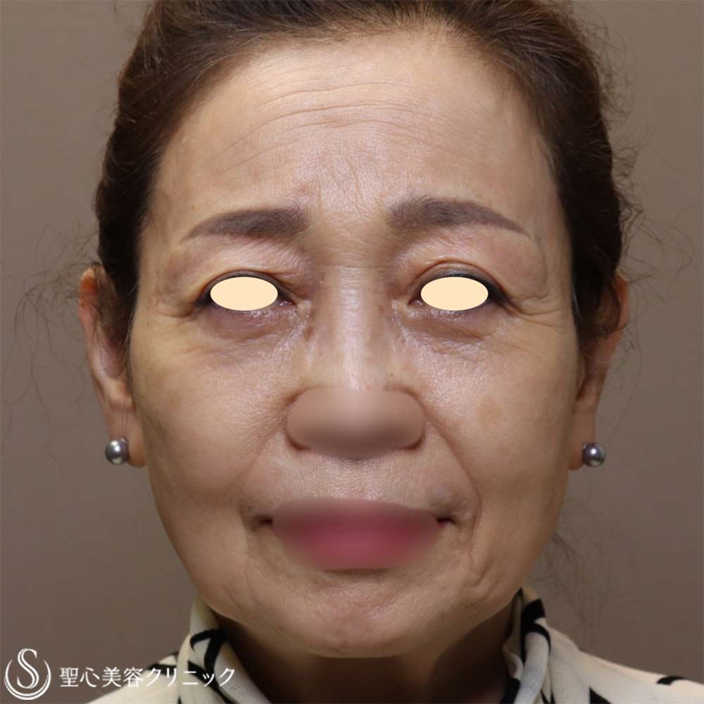 【70代女性・お顔全体の若返り】プレミアムPRP皮膚再生療法（6ヶ月後） After 