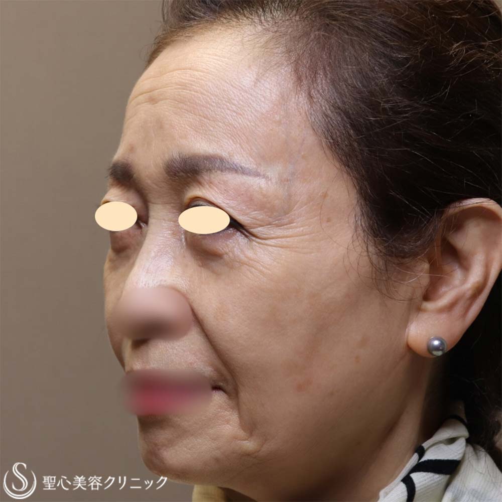 【70代女性・お顔全体の若返り】プレミアムPRP皮膚再生療法（6ヶ月後） After 