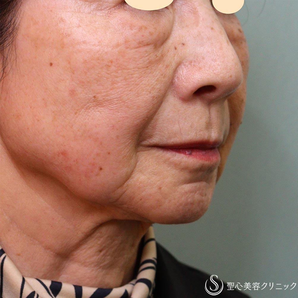 【70代女性・目の下ほうれい線マリオネットライン】プレミアムPRP皮膚再生療法（3か月、９か月後） After 