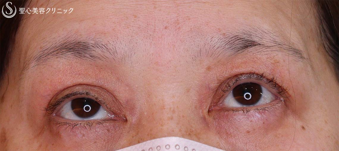 【50代女性・眼瞼下垂】眼瞼下垂埋没法（1ヶ月後） Before 