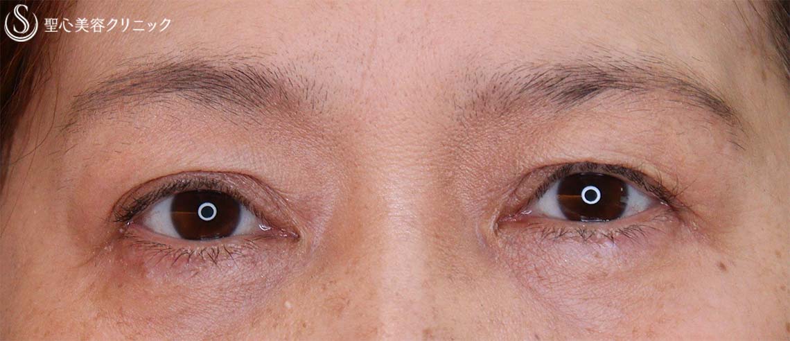 【50代女性・眼瞼下垂】眼瞼下垂埋没法（1ヶ月後） After 