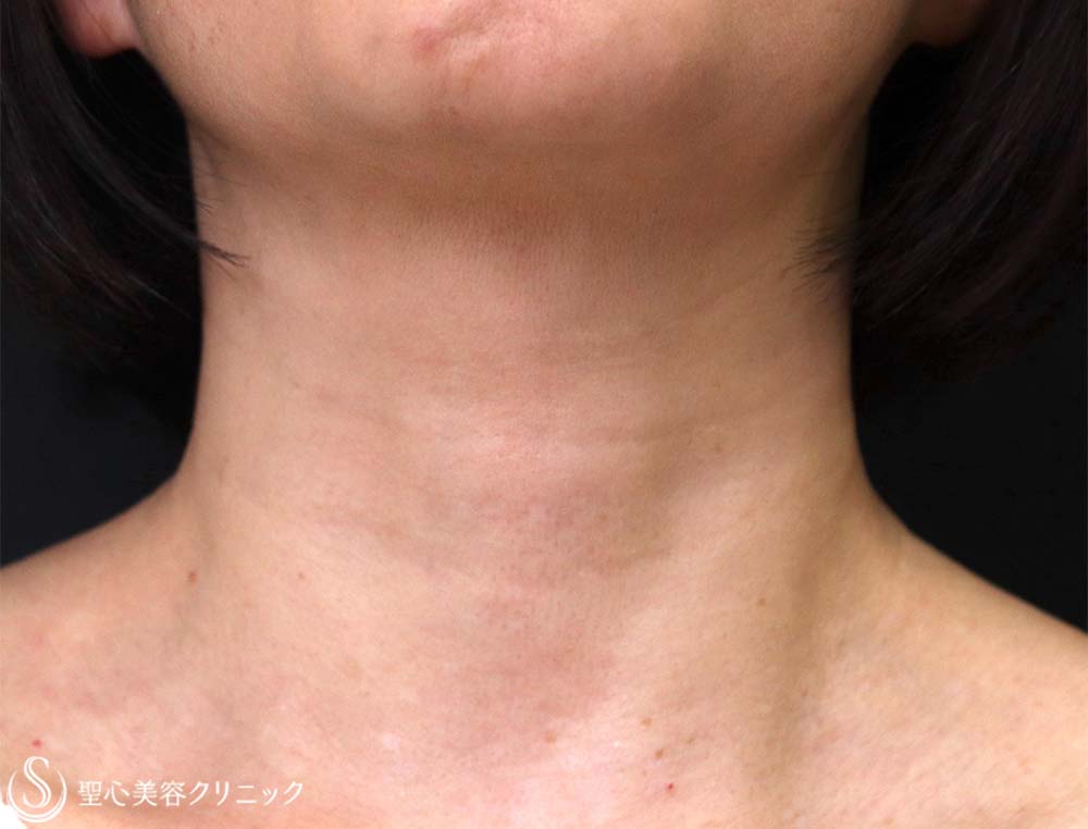 【50代女性・首のしわ】プレミアムPRP皮膚再生療法（1年後） After 