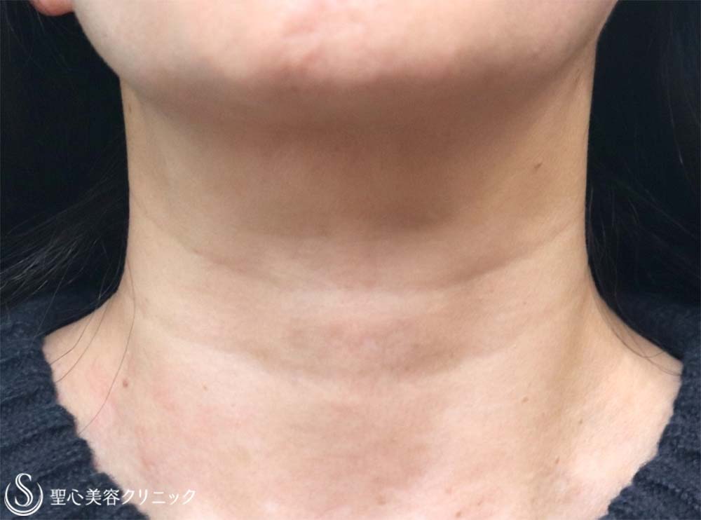 【50代女性・首のしわ】プレミアムPRP皮膚再生療法（1年後） Before 