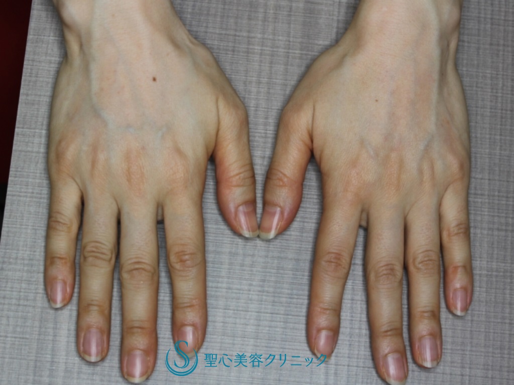 【50代女性・手の甲の若返り】プレミアムPRP皮膚再生療法（半年後） Before 