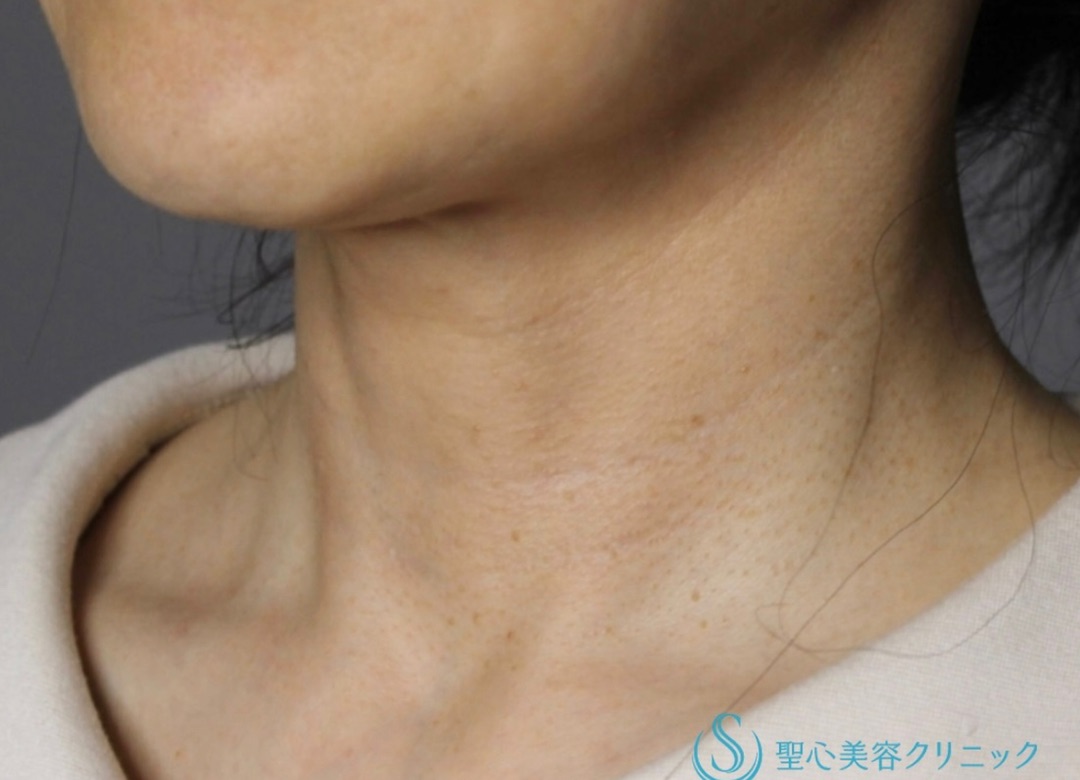 【50代女性・首の若返り】プレミアムPRP皮膚再生療法（半年後） Before 