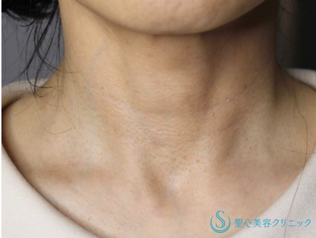 【50代女性・首の若返り】プレミアムPRP皮膚再生療法（半年後） Before 