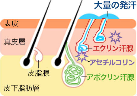 肌の断面図　大量の発汗