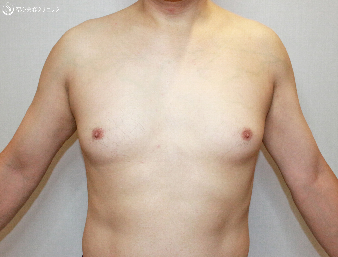 【50代男性・真性女性化乳房の長期経過】ベイザー脂肪吸引＆乳腺切除（10年後） Before 