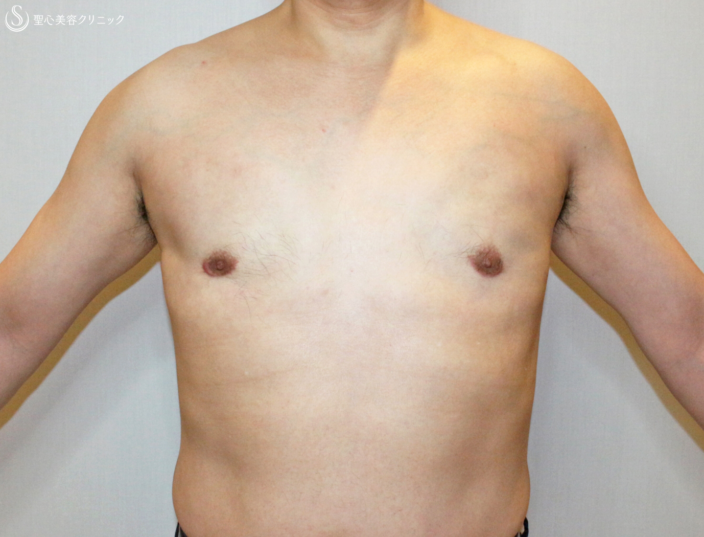 【50代男性・真性女性化乳房の長期経過】ベイザー脂肪吸引＆乳腺切除（10年後） Before 
