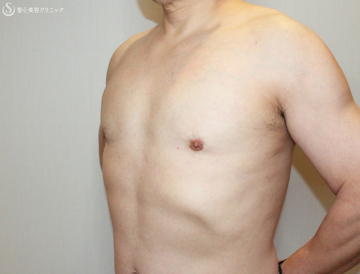 【50代男性・真性女性化乳房の長期経過】ベイザー脂肪吸引＆乳腺切除（10年後） After 