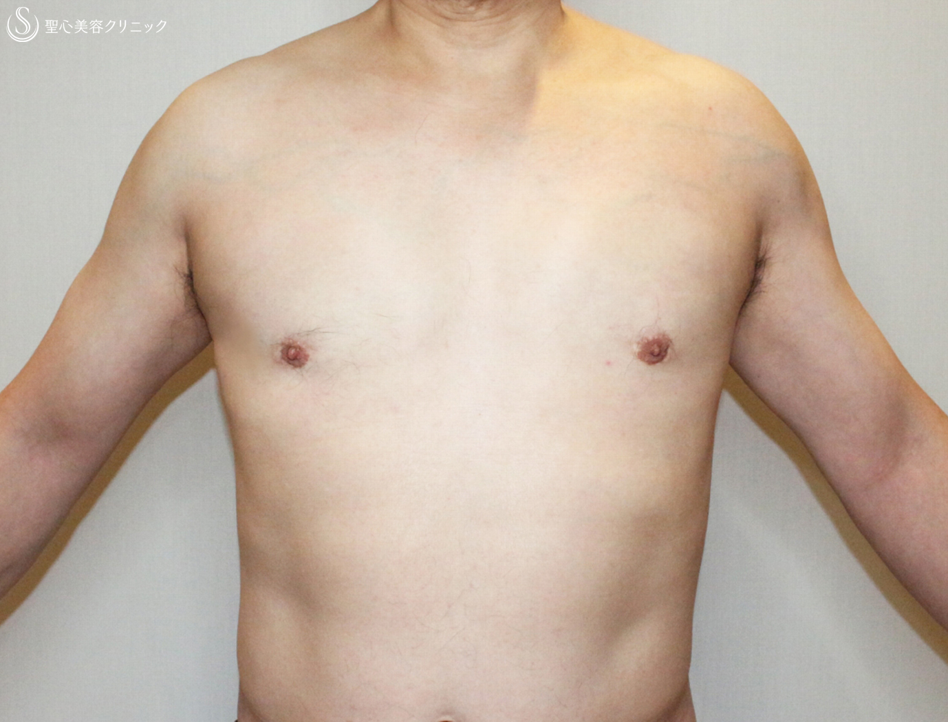 【50代男性・真性女性化乳房の長期経過】ベイザー脂肪吸引＆乳腺切除（10年後） After 