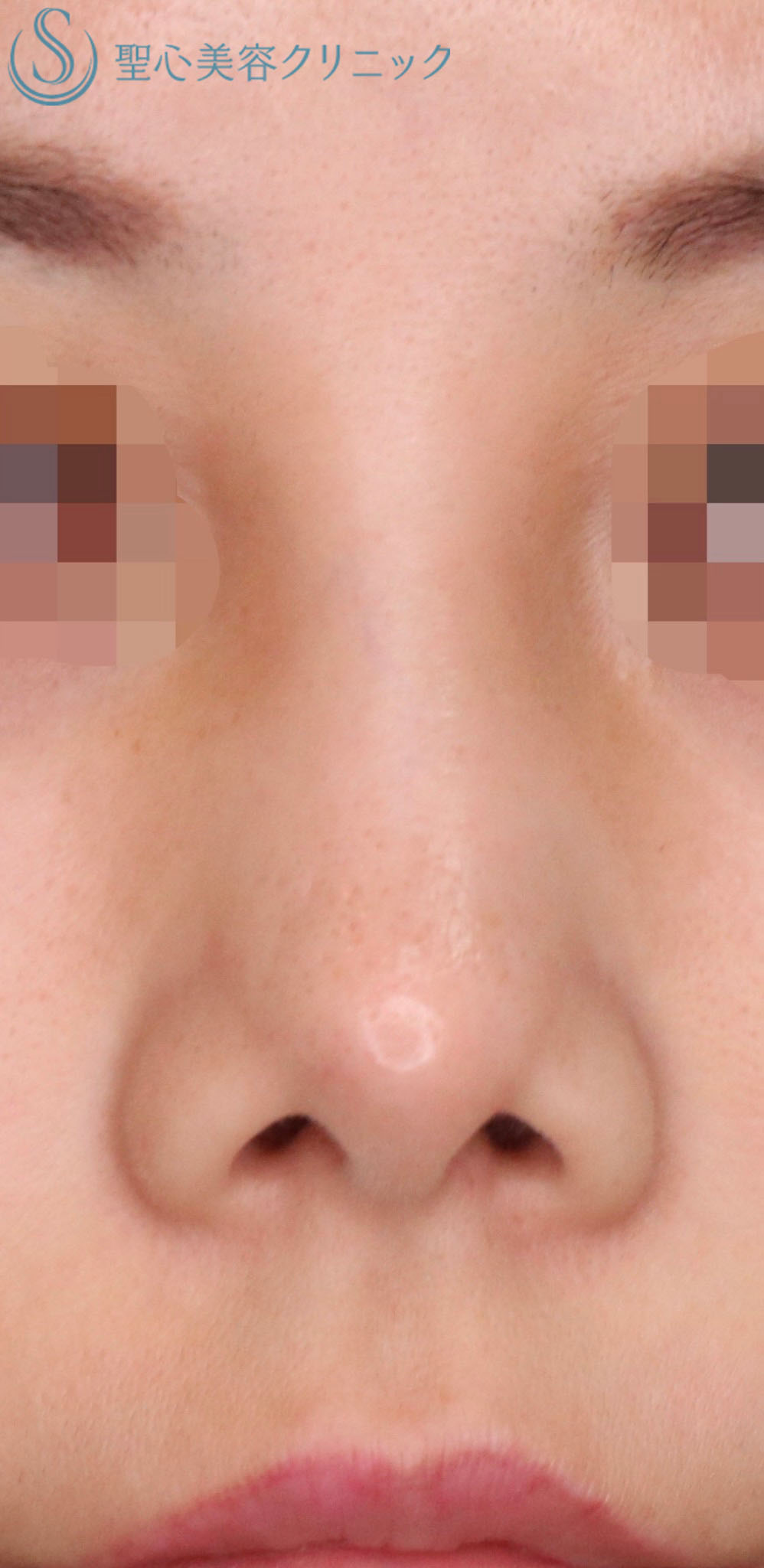 【20代女性・鼻の穴を目立ちにくくしたい！！】鼻孔縁下降術（術後3ヶ月） Before 