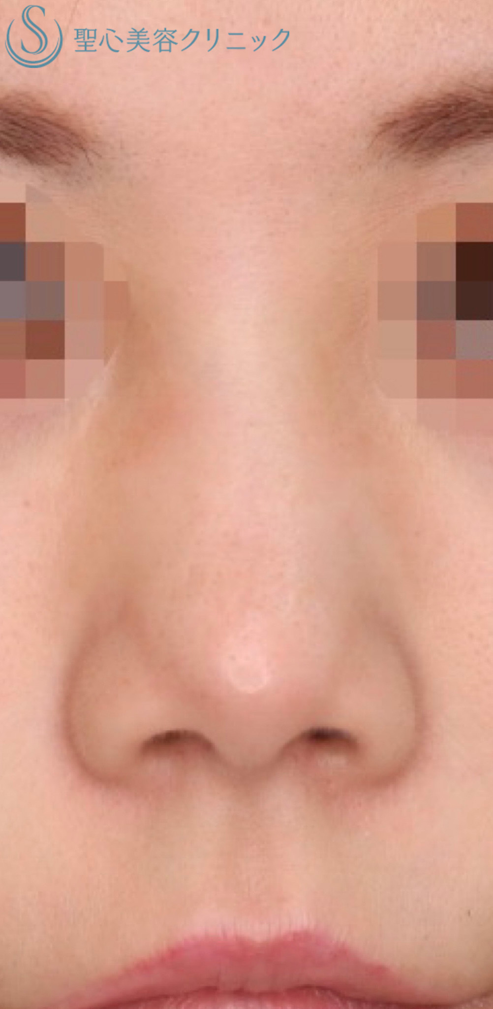 【20代女性・鼻の穴を目立ちにくくしたい！！】鼻孔縁下降術（術後3ヶ月） After 