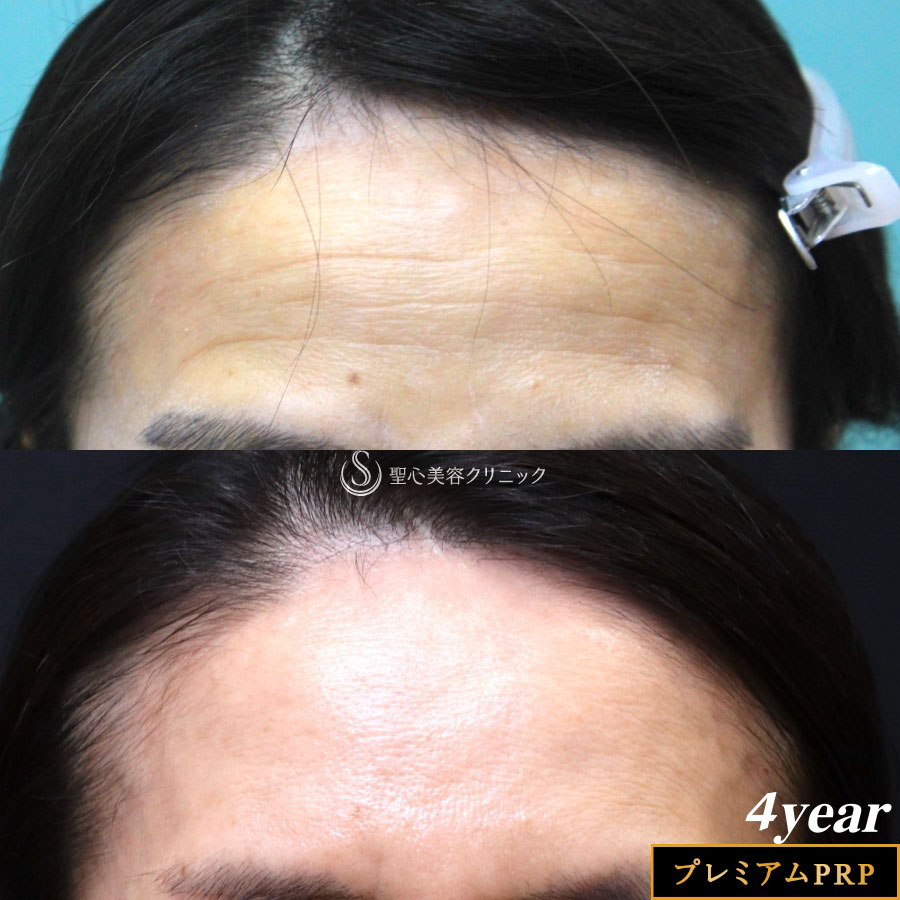 【50代女性・額の若返り】プレミアムPRP皮膚再生療法 （4年後） Before 