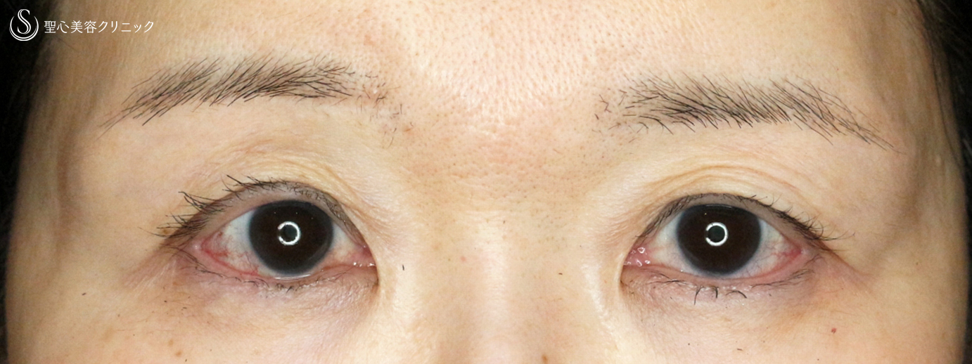 【50代女性・コンタクトレンズによる下垂に複合治療】切らない眼瞼下垂+α法＆眉下リフト（4年後） After 