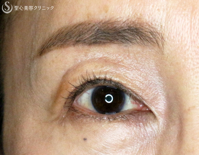 【40代女性・ハードコンタクトレンズ眼瞼下垂の長期経過】切らない眼瞼下垂+α法（9年後） After 